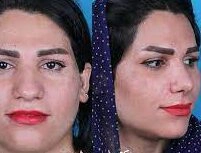 نمونه کارهای دکتر علی جمشیدی
بهترین متخصص پوست و زیبایی در بندرعباس