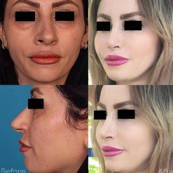 نمونه کارهای دکتر فردوس مذنبی بهترین جراح زیبایی بندرعباس