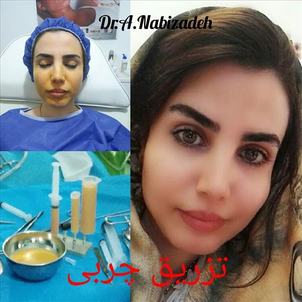نمونه کار دکتر علیرضا نبی زاده از بهترین دکتر زیبایی صورت بندرعباس